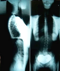 Illustrative spinal X-ray film showing side and front views